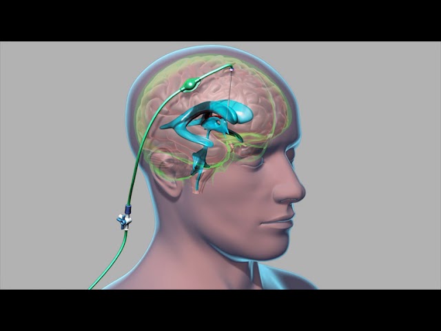 External Ventricular Drain (EVD) | Neutrify